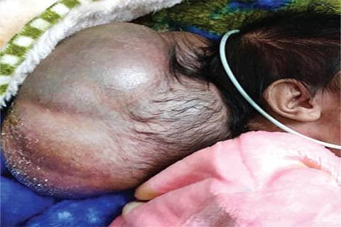 Baby with 'two heads'