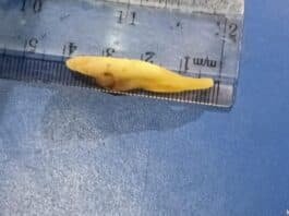 Doctors in central Kashmir claim to extract world’s longest tooth