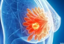 Breast Cancer in Kashmir: Experts flag late diagnosis, urge early detection and treatment Breast Cancer