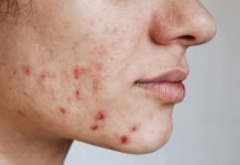 Can Anti-Scar Cream Remove Old Scars? A young woman with face scars