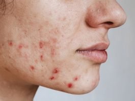 Can Anti-Scar Cream Remove Old Scars? A young woman with face scars